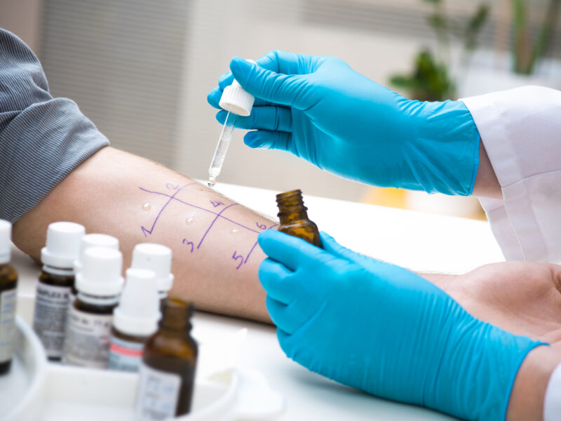 Skin prick allergy test